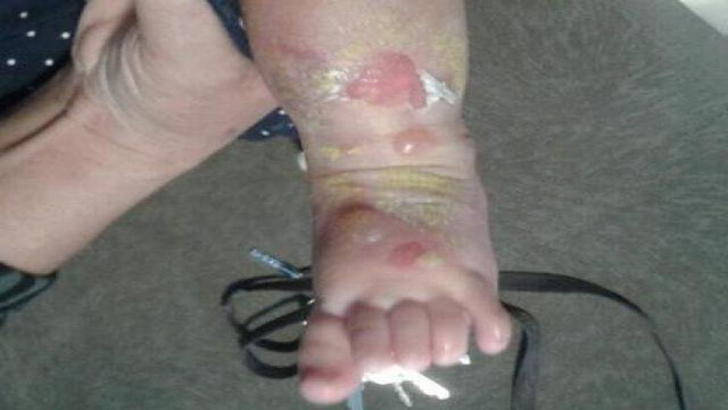 Bebê ficou com queimaduras no pé e em parte da perna. (Foto: Direto das ruas) /  