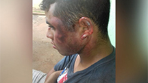 Rosto de Douglas Carneiro Cardoso após as agressões (Foto: Bruna Pasche) / Guilherme Henri e Bruna Pache 